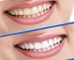 (Fraise)Bandes de blanchiment des dents / Édition limitée (15 traitements)